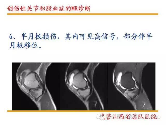  篮网西蒙斯膝盖酸痛休战,MRI检查显示无结构性损伤  